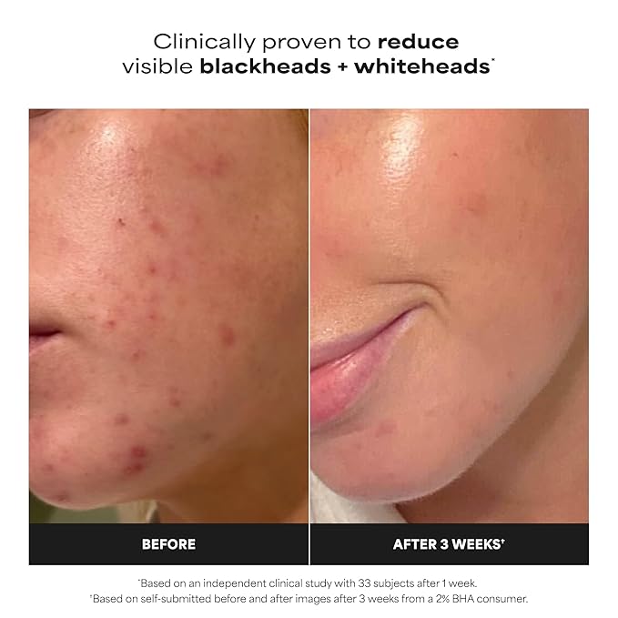 PAULA'S CHOICE SKIN PERFECTING 2% BHA Liquid Salicylic Acid Exfoliant-Facial Exfoliant for Blackheads, Enlarged Pores, Wrinkles, Fine Lines- 30 ml Bottle (Travel Size)