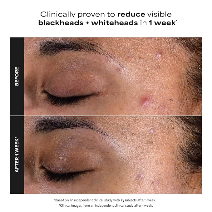 PAULA'S CHOICE SKIN PERFECTING 2% BHA Liquid Salicylic Acid Exfoliant-Facial Exfoliant for Blackheads, Enlarged Pores, Wrinkles, Fine Lines- 30 ml Bottle (Travel Size)