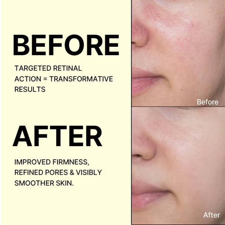 Celimax Vita-A Retinal Shot Tightening Booster with 0.1% Retinal, Matrixyl & Niacinamide | Pore Minimizer, Wrinkles & Fine Lines, Firmer Skin, Korean Face Serum (15ml)